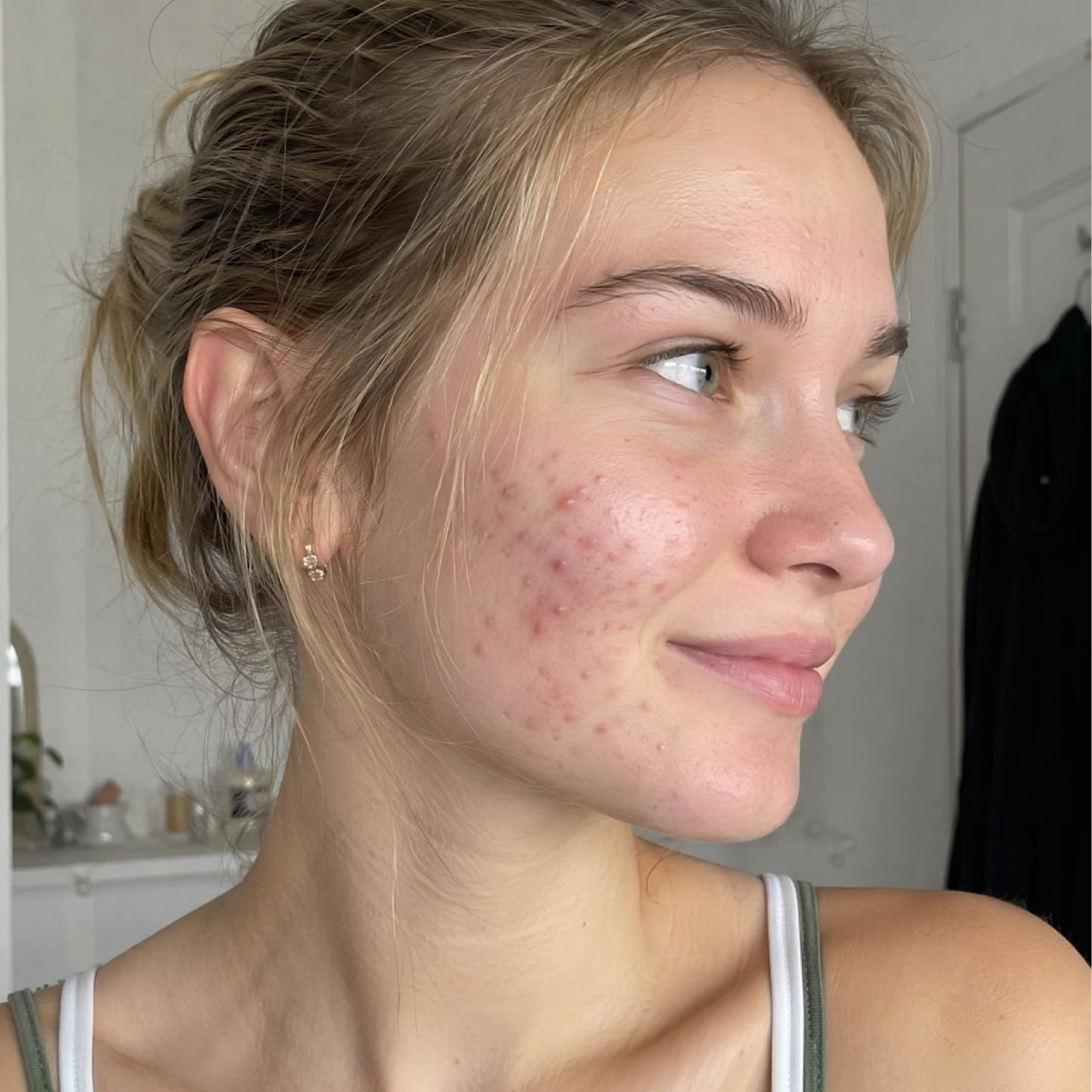 A face with pimples